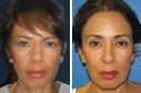 Before & After Photos